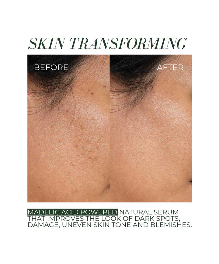 Clear + Bright Mandelic Acid Serum Drops for Acne & Hyperpigmentation - Brightening Facial Treatment for Glowing Skin | Perfect for Nighttime Skincare Routine