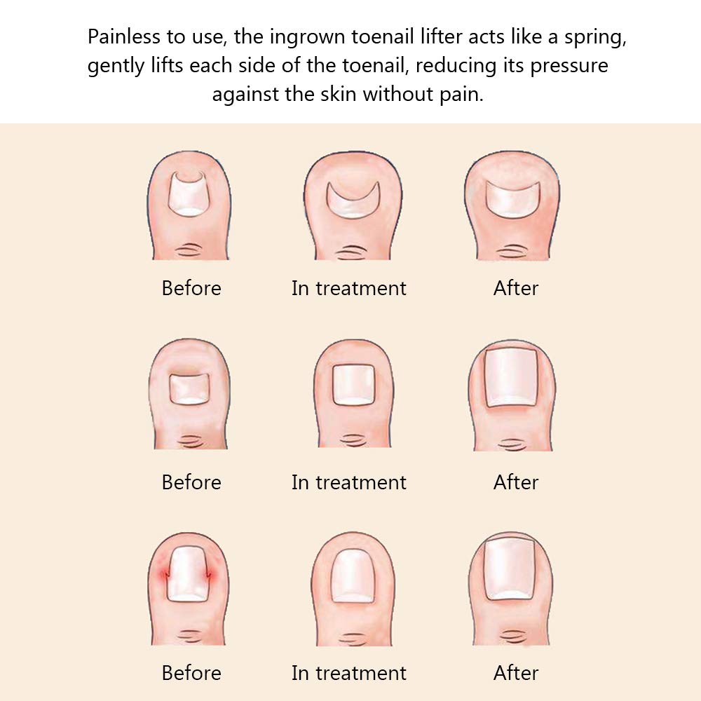 Ingrown Toenail Corrector Tool - Pain Relief Treatment for Ingrown Nails & Paronychia - Perfect for Home Pedicure and Foot Care Routine