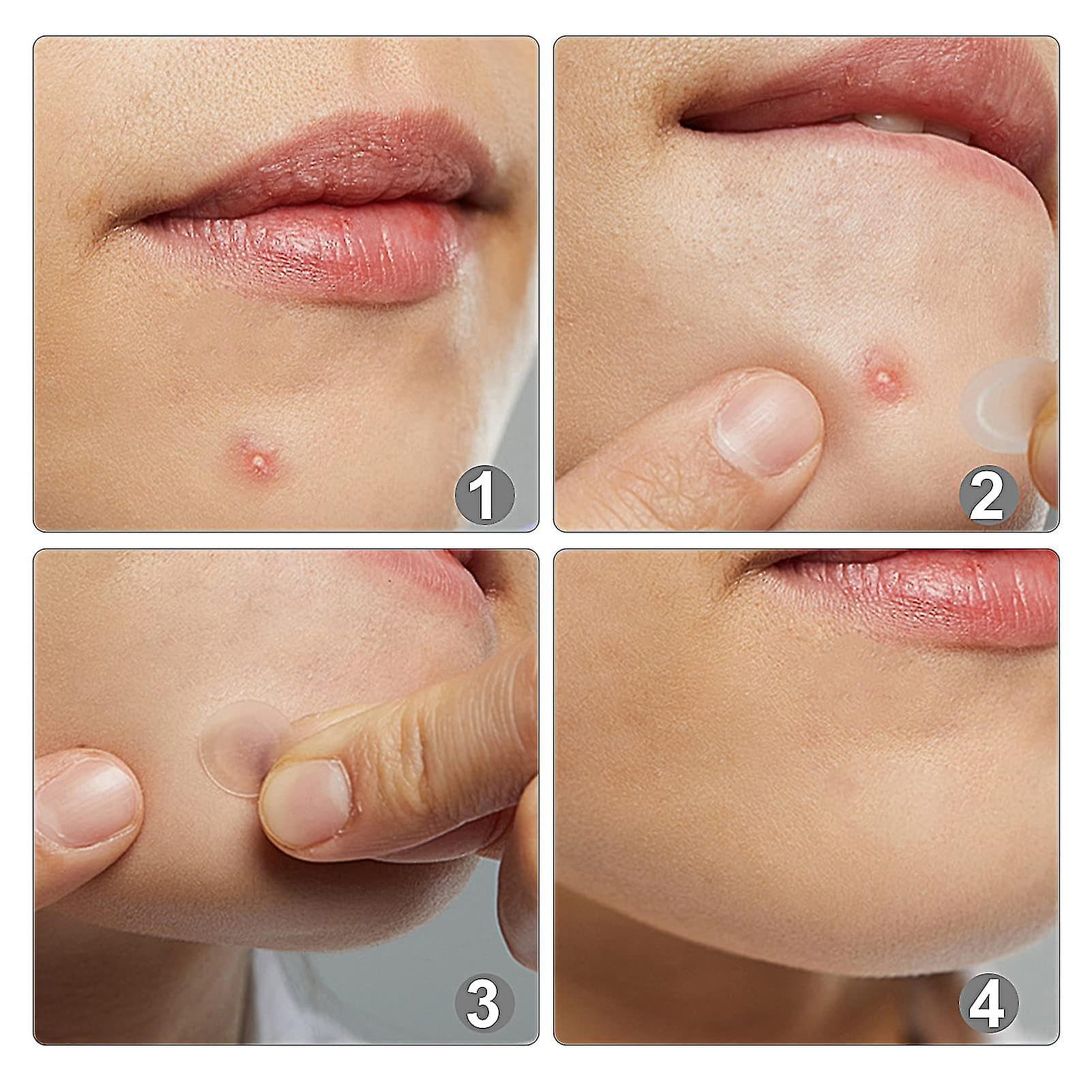Hydrocolloid Pimple Patches for Acne Treatment - 36 Count, Two Sizes (12mm & 48mm) - Invisible Acne Spot Cover for Overnight Healing - Perfect for Face, Back & Body Breakouts - Ideal for Travel & Daily Skincare Routine