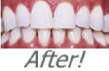 Professional Teeth Whitening Gel Syringe - 36% Carbamide Peroxide, 10ml for Instant White Smiles - Includes Whitening Trays - Perfect for At-Home Teeth Whitening & Brightening Your Smile for Special Occasions
