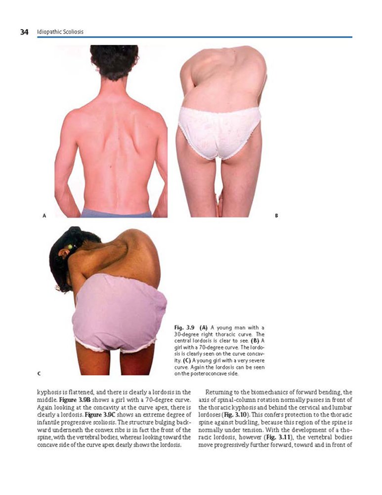 Idiopathic Scoliosis Treatment Guide - Harms Study Group Recommendations for Spinal Correction & Pain Relief | For Doctors, Physical Therapists & Patients