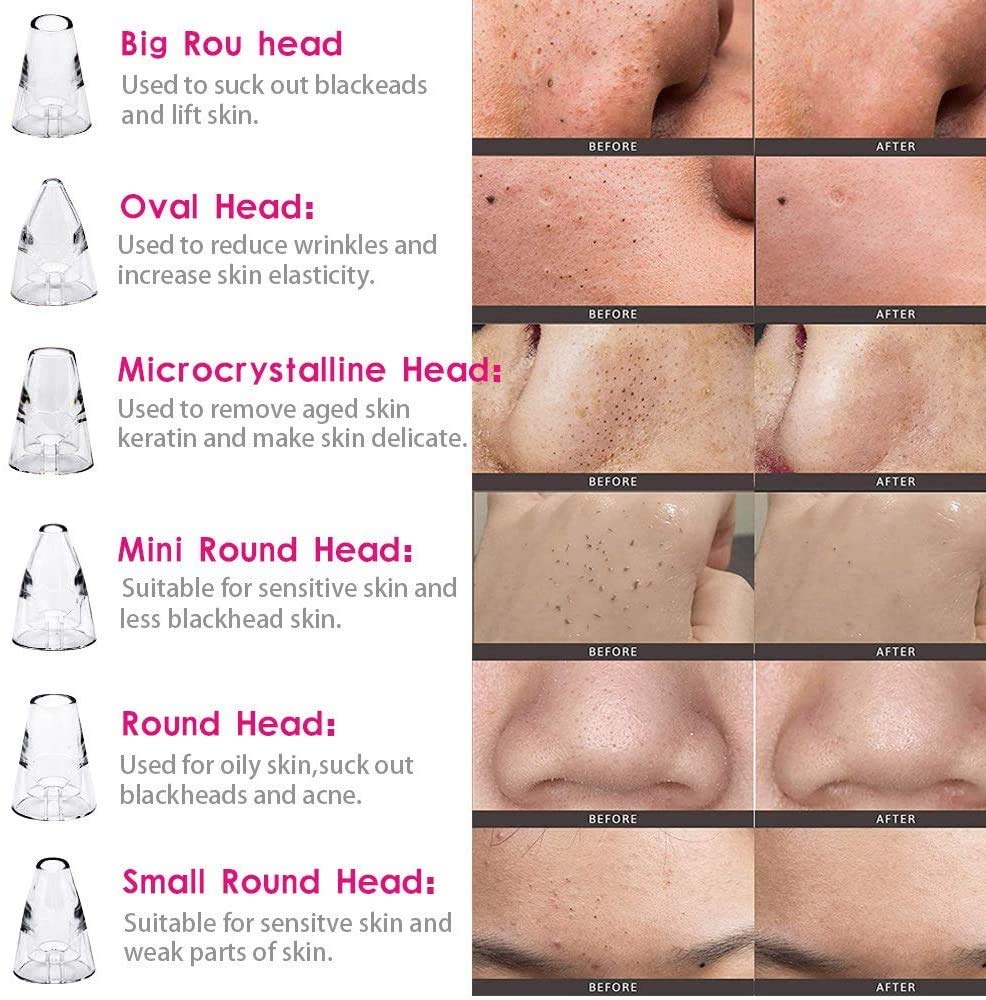 Premium 6-in-1 Blackhead Remover Vacuum - Rechargeable Pore Cleaner with 3 Adjustable Modes & 6 Attachments for Blackheads, Whiteheads & Acne | Professional Skin Care Device for Men & Women | Perfect for Daily Facial Cleansing & Spa Treatments