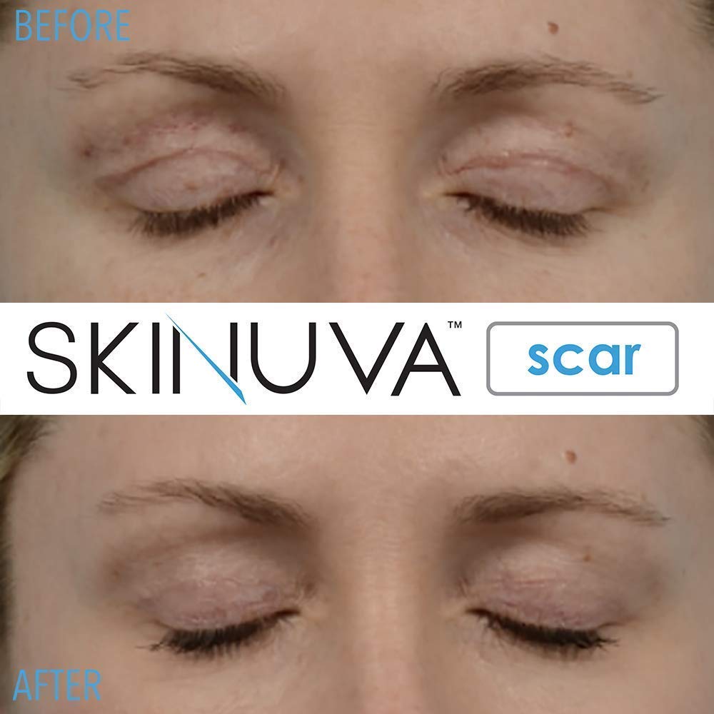 Skinuva® Next Generation Scar Cream & Brite Dark Spot Treatment Set (1 oz Each) | Advanced Scar Removal & Skin Brightening Formula with Growth Factors | Perfect for Post-Surgery, Acne Scars & Hyperpigmentation