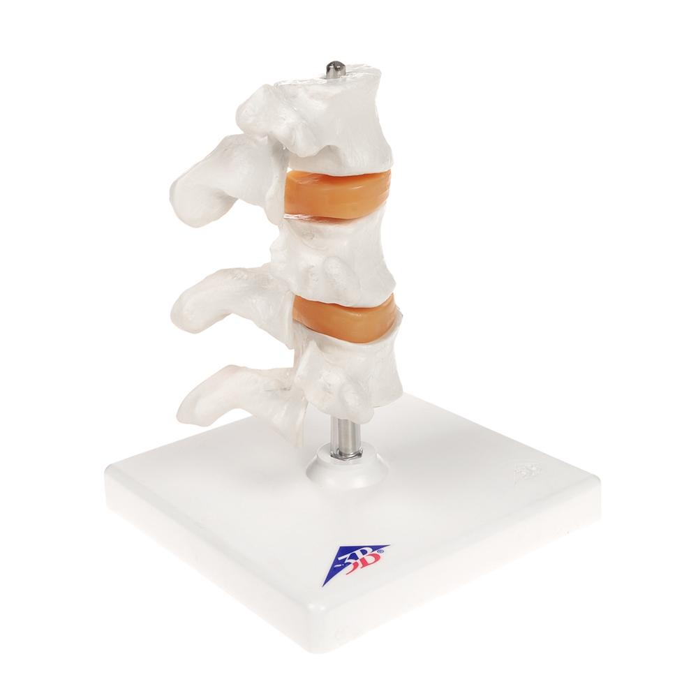Premium Osteoporosis Bone Model - Anatomically Accurate Skeletal Display for Medical Education & Patient Demonstration - Perfect for Classrooms, Clinics, and Healthcare Training