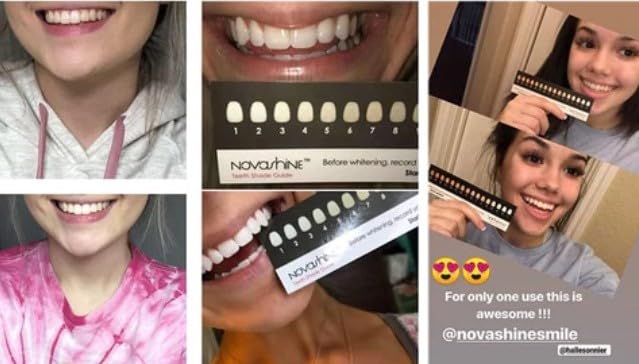 Novashine Teeth Whitening Kit Bundle - Professional Whitening Gel Refill & Whitening Pen for Brighter Smile | At-Home Teeth Whitening Solution for Daily Use & Travel