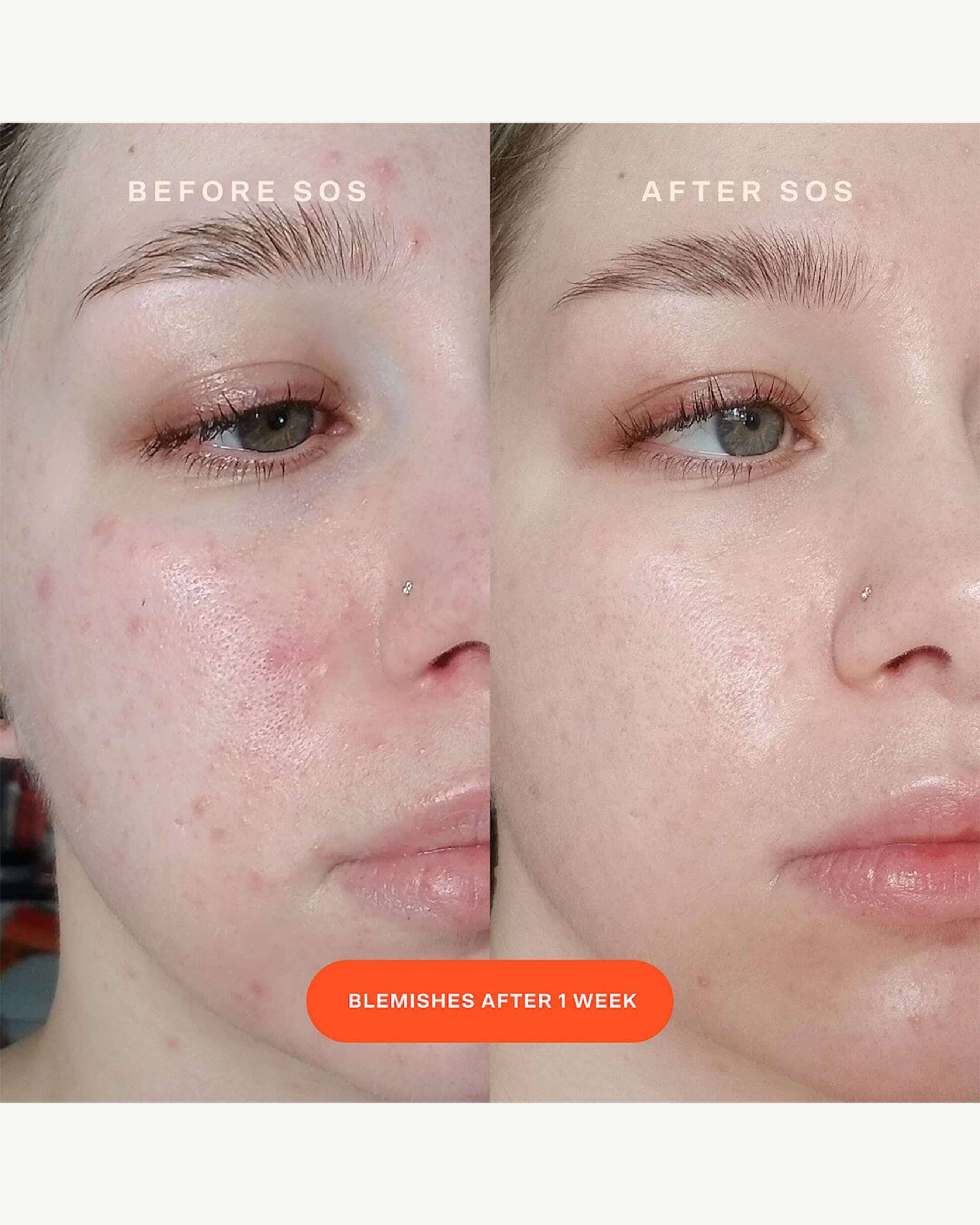 SOS Intensive Rescue Serum - Hydrating & Anti-Aging Face Serum for Dry Skin - Perfect for Night Routine & Travel Skincare