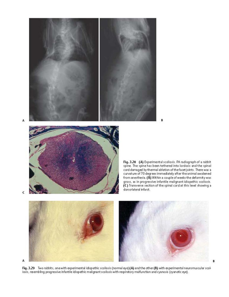 Idiopathic Scoliosis Treatment Guide - Harms Study Group Recommendations for Spinal Correction & Pain Relief | For Doctors, Physical Therapists & Patients