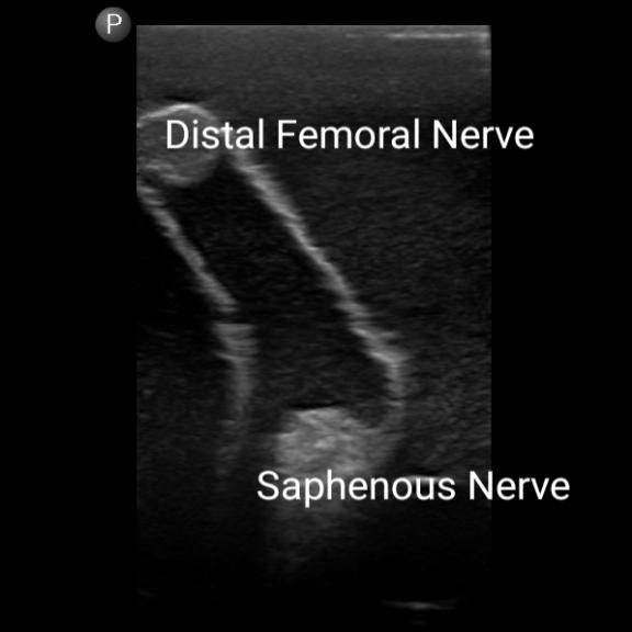 Gen II Femoral Vascular Access & Regional Anesthesia Ultrasound Training Model - Medical Simulation for Ultrasound-Guided Procedures Practice