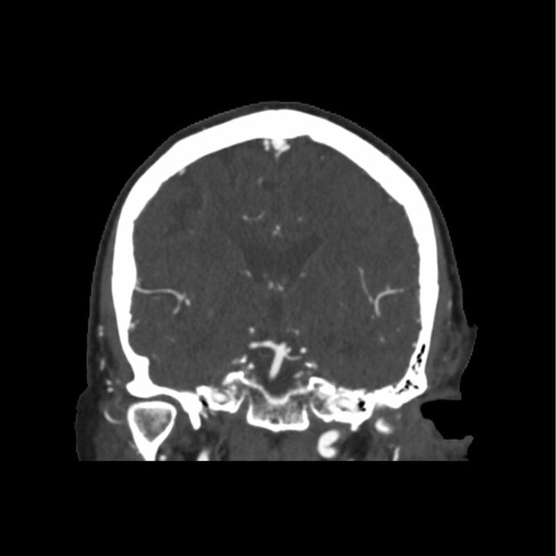 CTA Aneurysm Head Phantom for CT Scan and X-Ray Training - High-Quality Medical Simulation Tool for Radiology Education and Diagnostic Practice