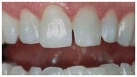INSTANT WHITE SMILES 36% Teeth Whitening Gel - Professional Deep Stain Removal with 2x10ml Syringes & 2 Remineralizing Trays | At-Home Whitening Kit for Coffee, Wine & Smoking Stains