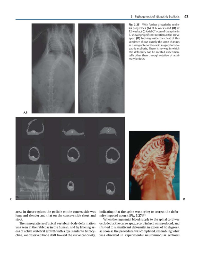 Idiopathic Scoliosis Treatment Guide - Harms Study Group Recommendations for Spinal Correction & Pain Relief | For Doctors, Physical Therapists & Patients