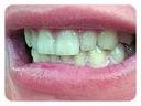 INSTANT WHITE SMILES 36% Teeth Whitening Gel - Professional Deep Stain Removal with 2x10ml Syringes & 2 Remineralizing Trays | At-Home Whitening Kit for Coffee, Wine & Smoking Stains