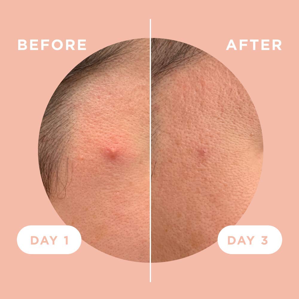 ZitSticka Killa Acne Patches & HydraDew Gel Moisturizer for Face - Fast Pimple Treatment & Hydrating Skincare for Clear Skin | Perfect for Overnight Spot Treatment & Daily Moisturizing Routine