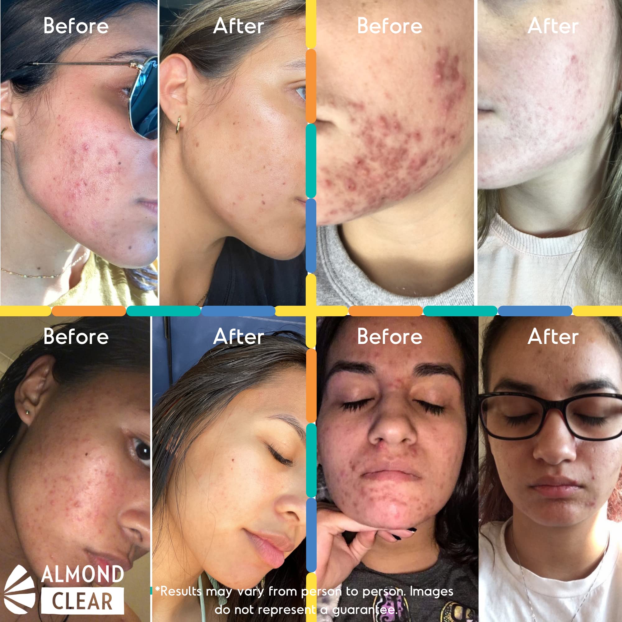 Best Face & Body Starter Kit for Oily Skin - Acne & Folliculitis Treatment Set with Cleanser & Serums | Daily Skincare Routine for Teens & Adults