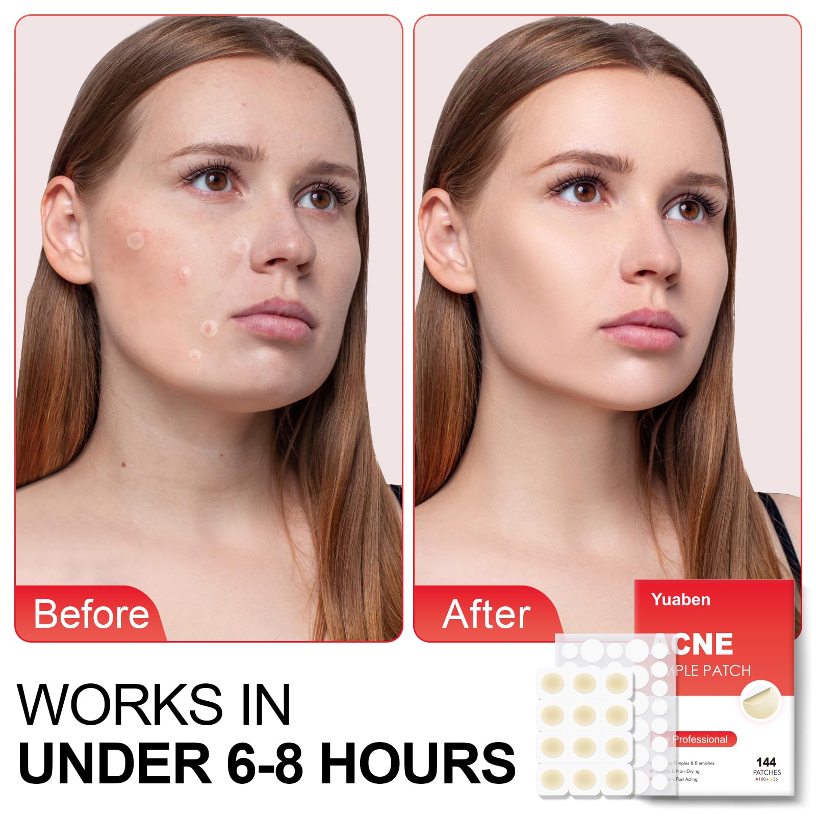 Hydrocolloid Acne Patches for Face - 144 Pcs (108 Day + 36 Night) with Salicylic Acid, Tea Tree & Calendula Oil - Effective Pimple Patches for Zits, Blackheads & Blemish Treatment - Perfect for Overnight Spot Treatment & Daily Acne Care