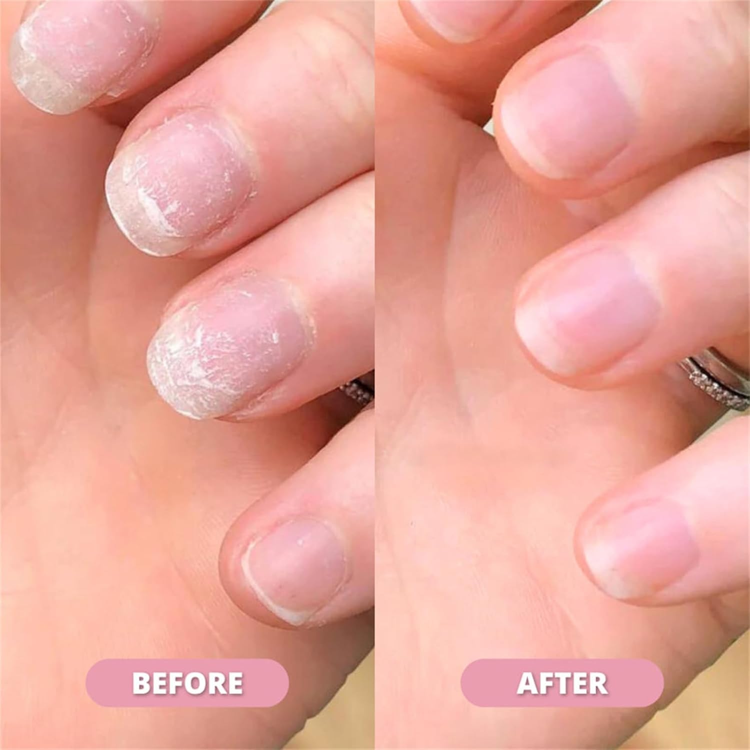Anperio Nail Growth Pen - Stem Cell Nail Serum & Cuticle Oil for Stronger, Healthier Nails - Moisturizing Nail Strengthener for Growth & Repair (5 Pack) - Perfect for Salon, Home Manicures & Nail Care Routine