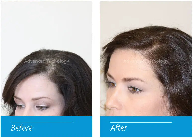 FoliGROWTH Ultimate Hair Growth Supplement - Natural Nutraceutical for Thicker, Stronger Hair | Perfect for Men & Women with Thinning Hair or Hair Loss