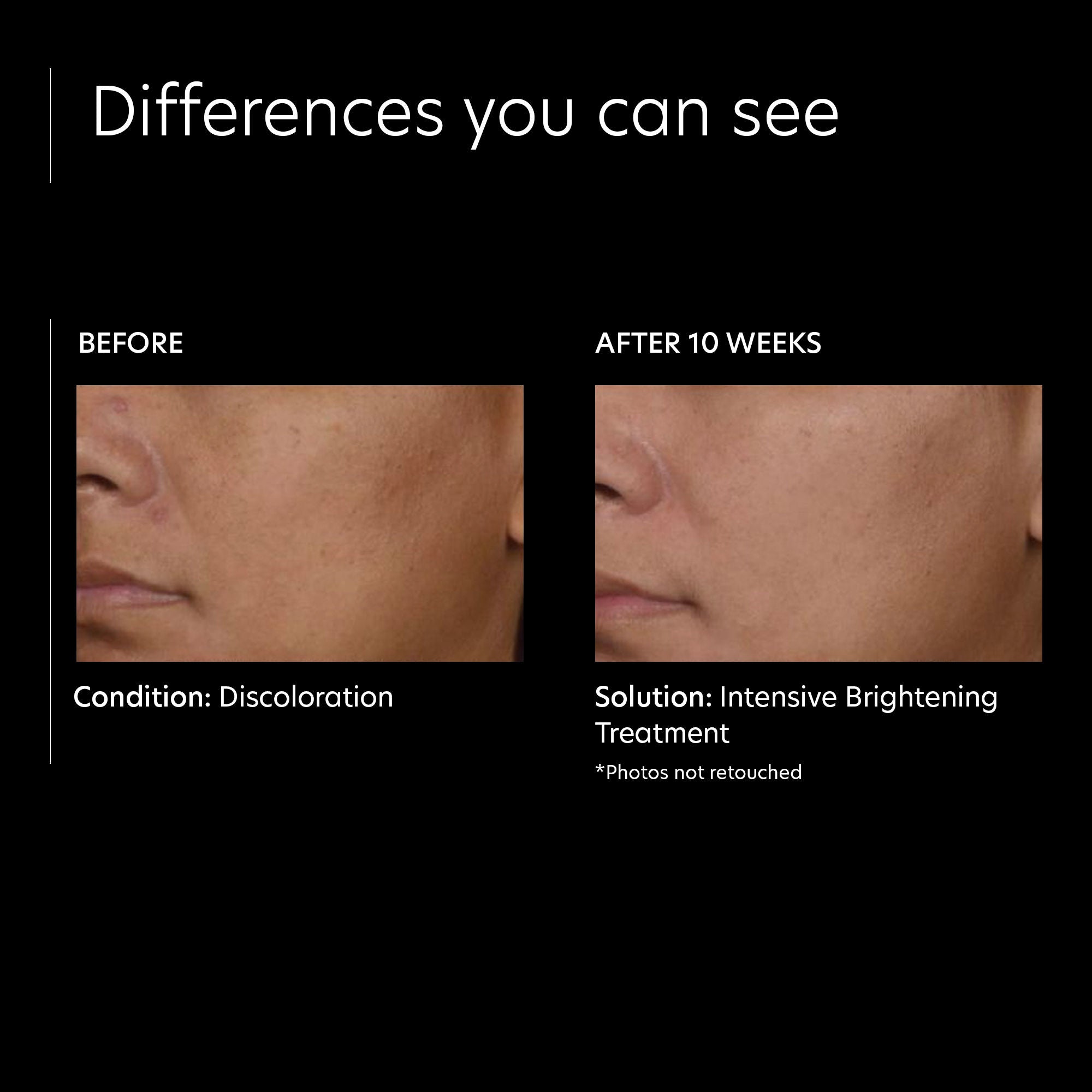Best Intensive Brightening Treatment for Glowing Skin - Brighten & Even Skin Tone for Day & Night Use