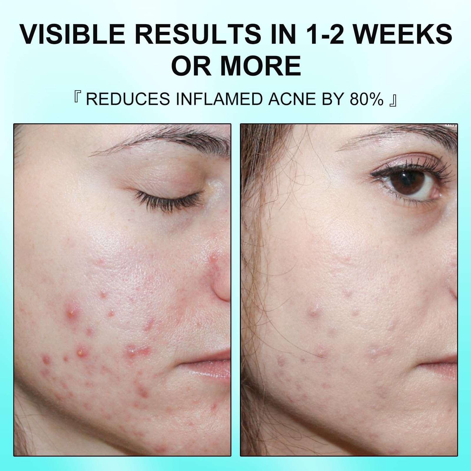 Best Acne Treatment Cream for Face, Back & Body - Pimple, Blemish & Blackhead Spot Remover with Natural Ingredients - Oil Control for Teens, Women & Men - Perfect for Daily Skincare & Breakout Prevention