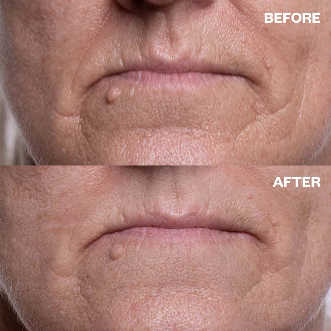 Anti-Aging Lip & Mouth Wrinkle Patches - Hydrating Collagen Treatment for Smile Lines & Fine Lines | Perfect for Nighttime Skincare & Pre-Makeup Application