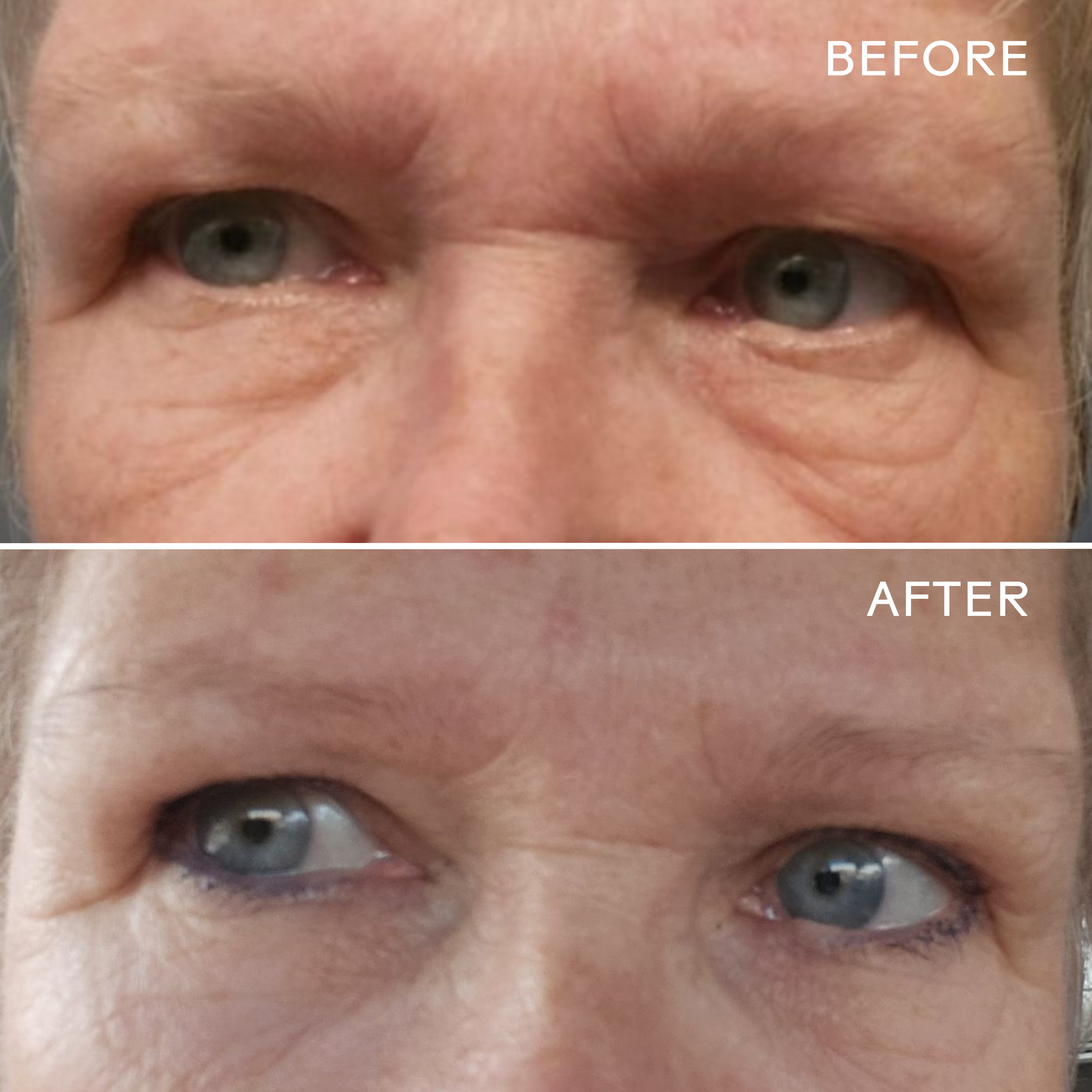EyeHero™ Bio Retinol Smoothing Eye Cream - Anti-Aging & Wrinkle Reduction for Dark Circles & Puffiness - Perfect for Nighttime Skincare Routine & Travel