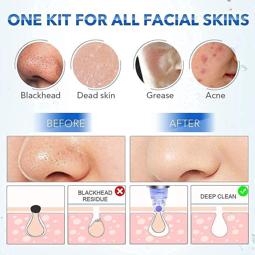 BEAMBOX 4-in-1 Blackhead Remover Vacuum Kit - Professional Pore Cleaner & Acne Treatment for Men & Women - Skin Care Tool for Blackhead Removal, Pimple Extraction & Facial Cleansing - Perfect for Home Spa & Daily Skincare Routine