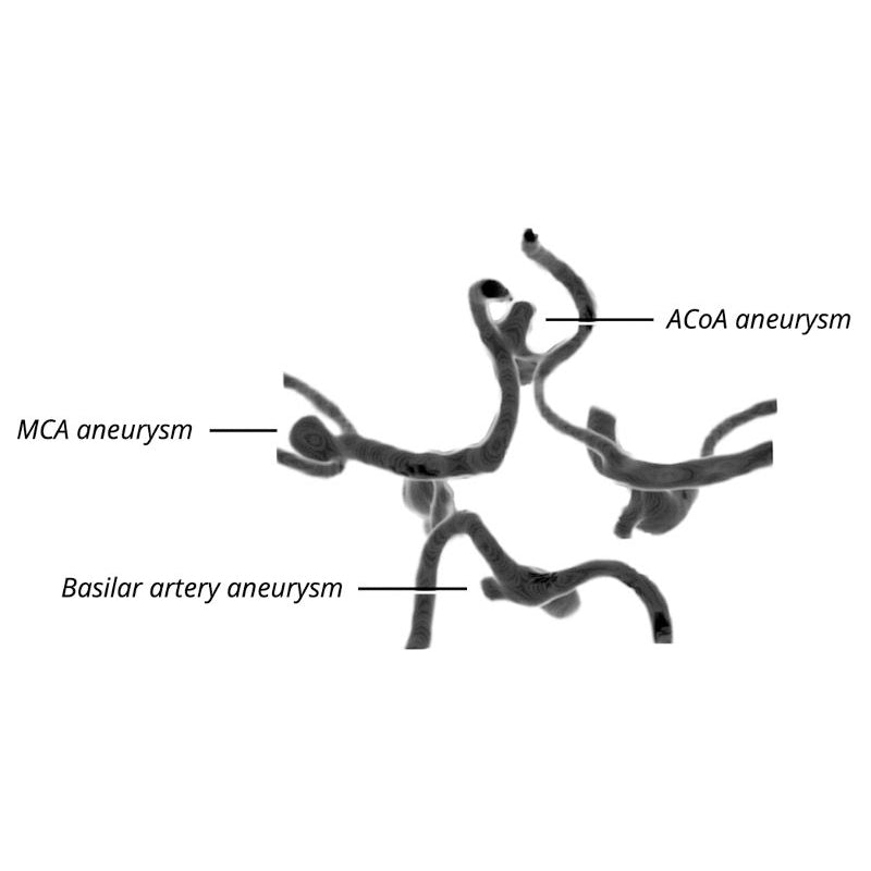 CTA Aneurysm Head Phantom for CT Scan and X-Ray Training - High-Quality Medical Simulation Tool for Radiology Education and Diagnostic Practice