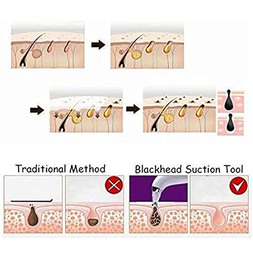 Viulvuk 4-in-1 Electric Blackhead Remover Vacuum Suction Tool | Professional Pore Cleaner for Face & Nose | Whitehead & Acne Treatment | Perfect for Home Skincare & Spa Facial Care
