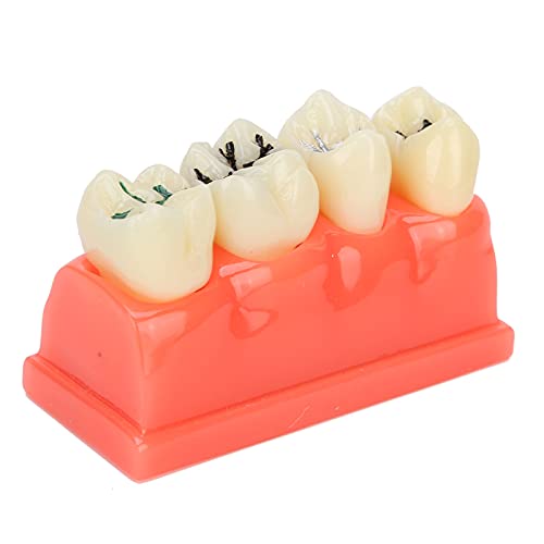 Dental Caries Model - High-Quality Clear Tooth Education Display for Dental Clinics & Schools | Durable, Portable & Practical for Teaching & Training