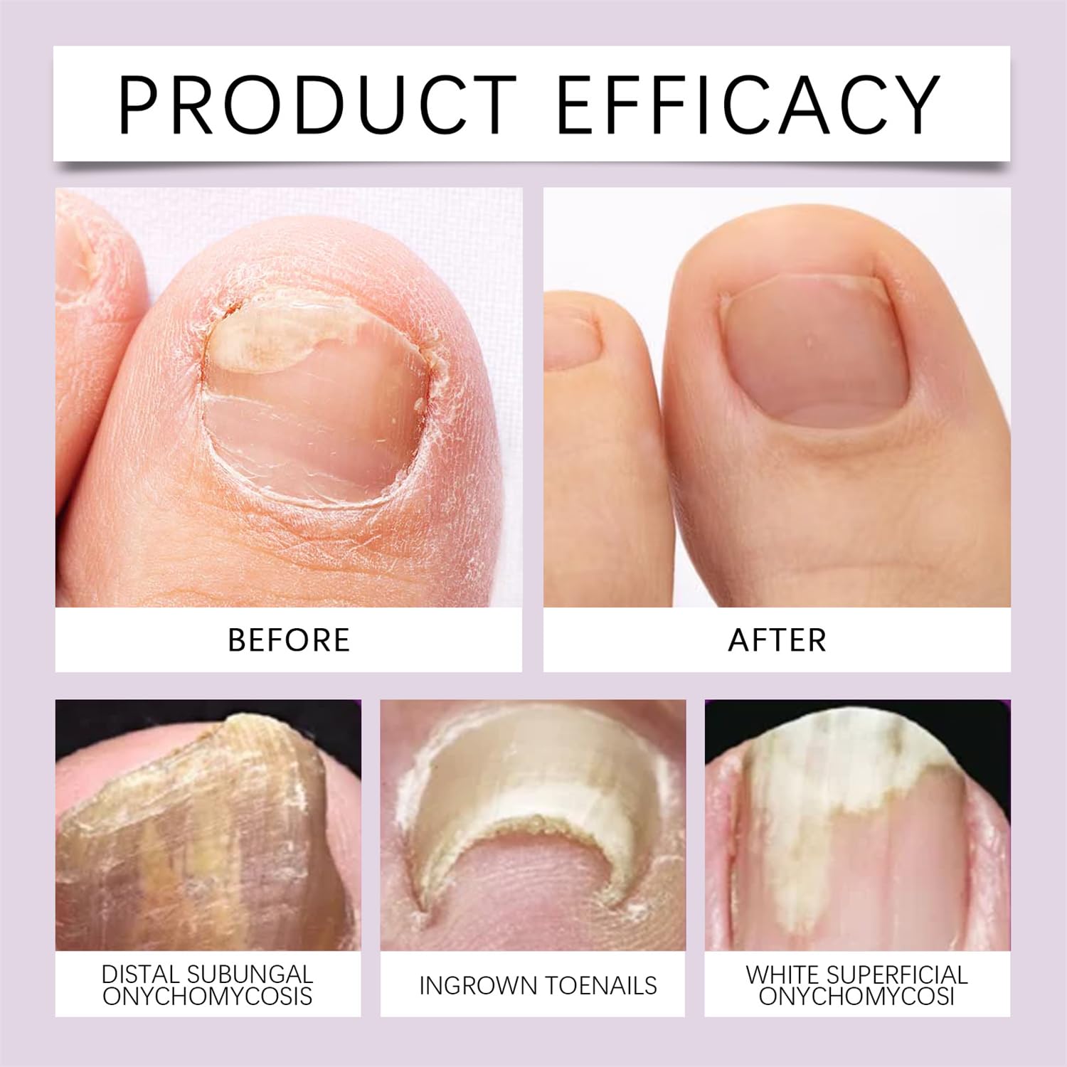 Bee Venom Nail & Foot Care Solution - Soothing Serum & Soft Nail Cream with Brush for Athlete's Foot, Thick Toenails, Cracked & Discolored Nails - 1pc - Perfect for Daily Foot Care & Nail Repair at Home