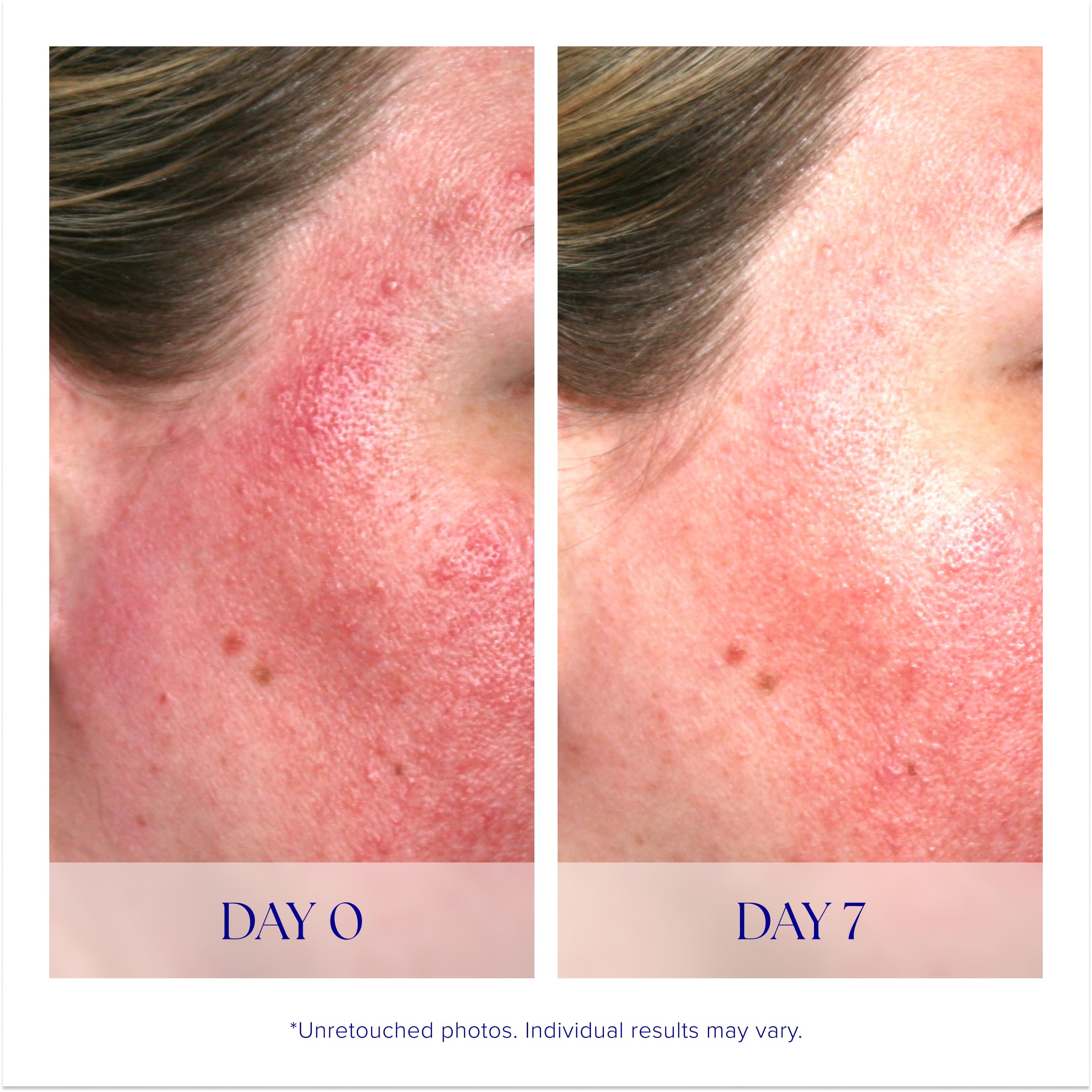 Pro-Heal Serum Advance+ - Antioxidant-Rich Vitamin C, E & A Facial Serum for Redness, Rosacea & Inflammation Relief | Brightening & Soothing Skincare for Sensitive Skin