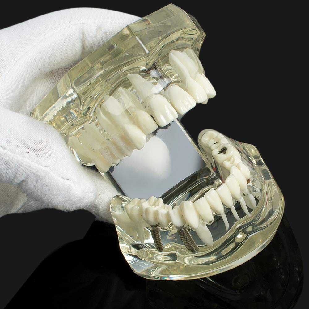Dental Teeth Model - Transparent Implant Disease Removable Tooth Demonstration Kit for Dental Students & Professionals | Perfect for Classroom Teaching, Clinical Training & Patient Education