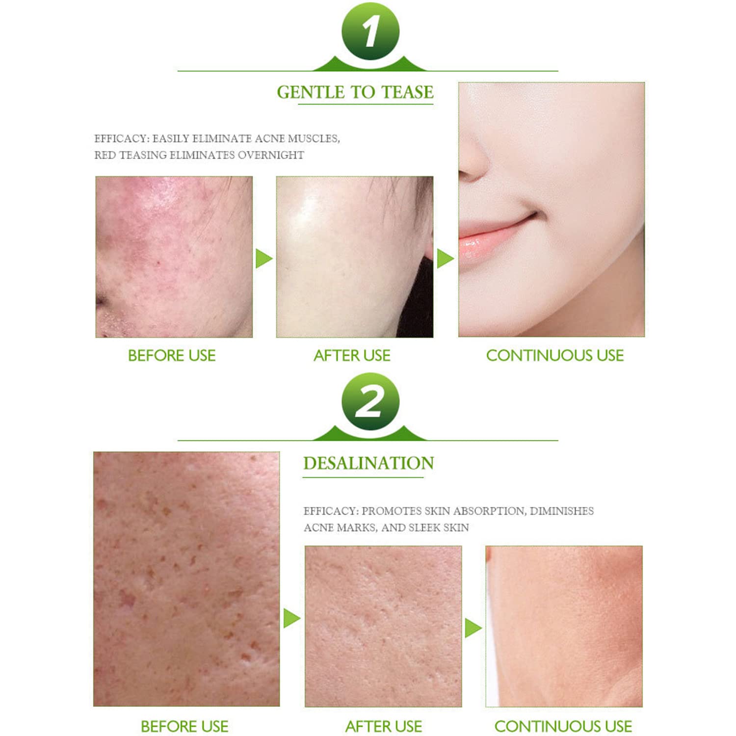 AICHUN BEAUTY Acne Treatment Cream - 30ml/1.0fl.oz Facial Cleanser for Pimple, Blackhead & Comedone Removal | Skin Repair & Oil Control | Perfect for Daily Acne-Prone Skin Care Routine