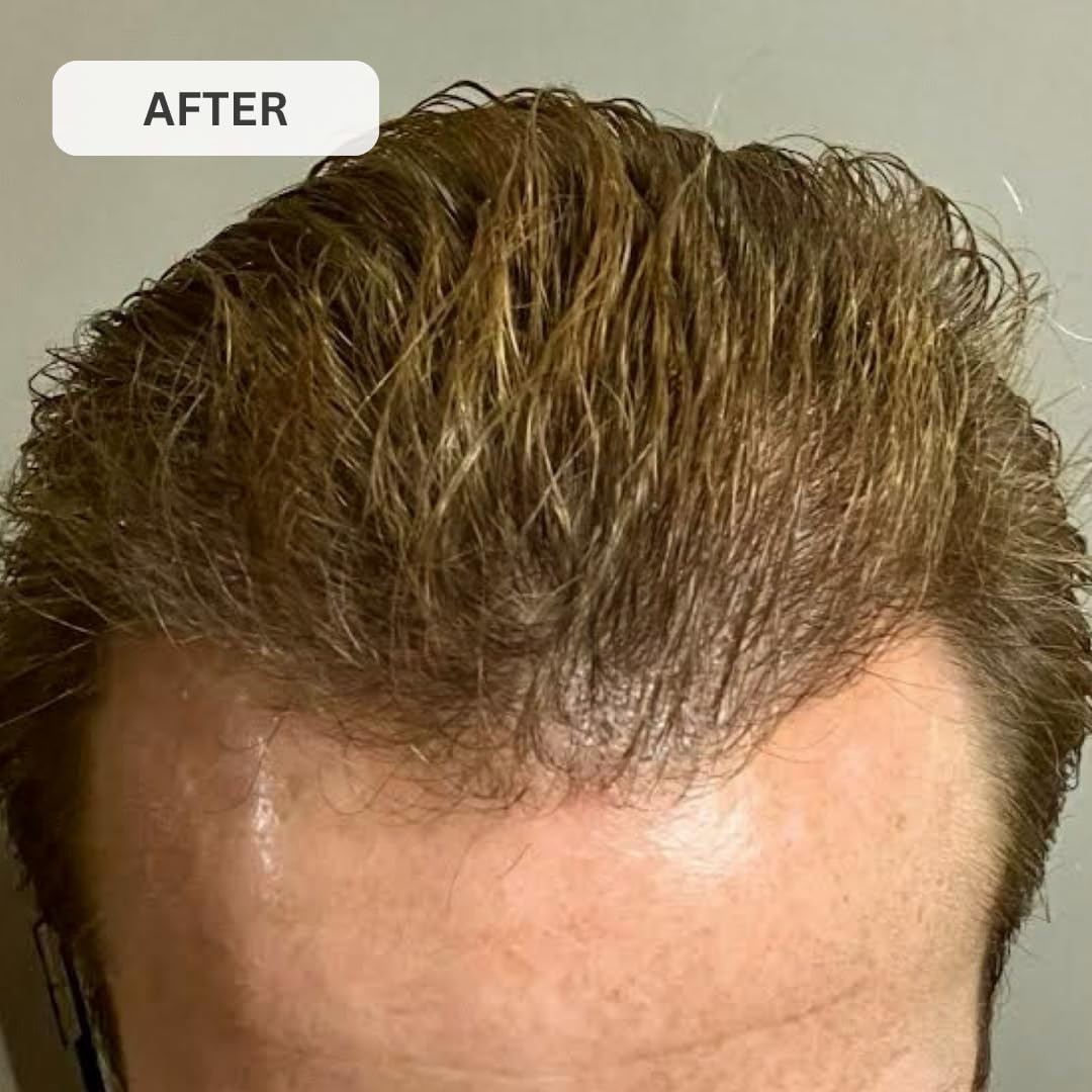 272 MD Elite Complete Hair Growth System - Laser Cap, Shampoo, Conditioner & Vitamins for Thicker Hair | At-Home Hair Regrowth Treatment for Men & Women | Perfect for Thinning Hair & Receding Hairline