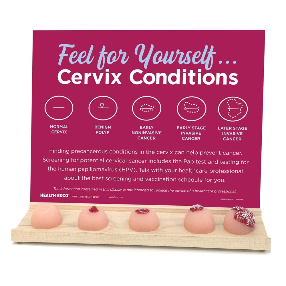 Cervix Conditions Display Model - Female Reproductive System Anatomy Educational Tool for Medical Students & Healthcare Professionals - Perfect for Gynecology Training & Patient Education