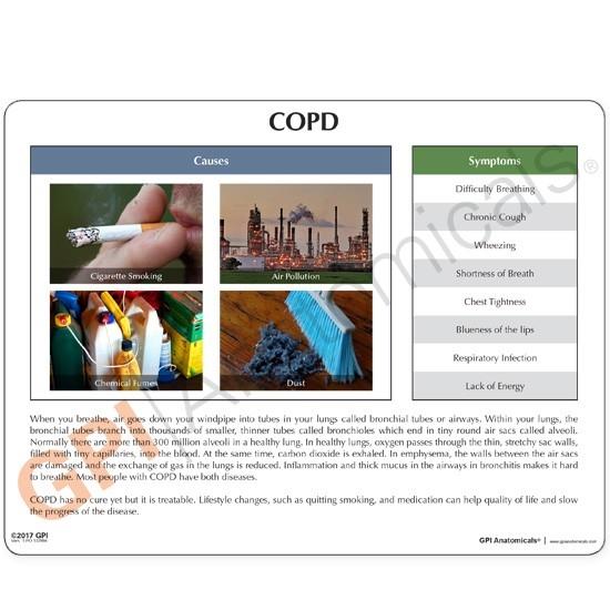 COPD 4-Piece Enlarged Anatomical Model - Medical Education Tool for Respiratory Disease Study & Classroom Demonstration
