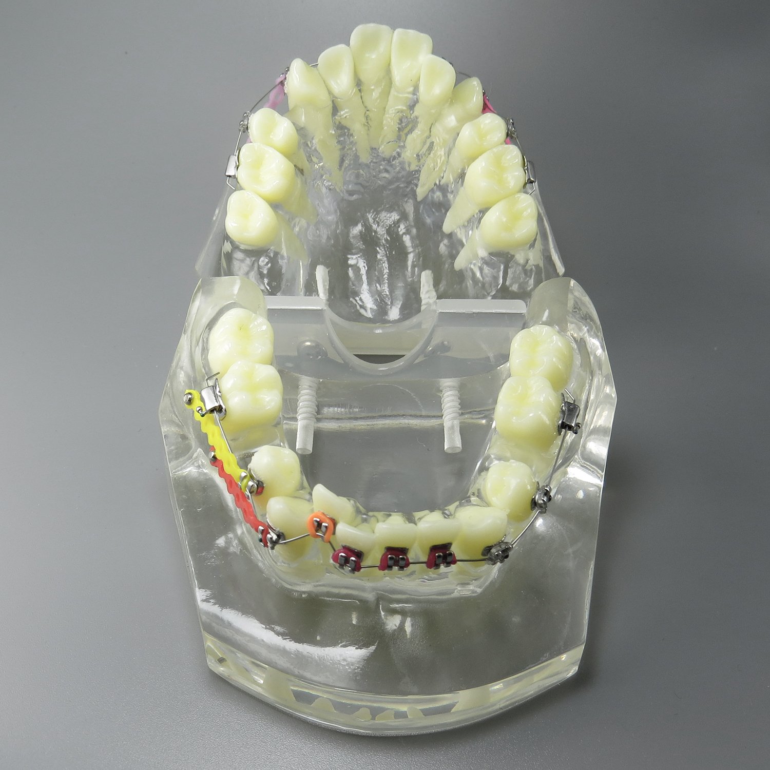 Orthodontic Teeth Model with Metal Brackets & Wires - Dental Malocclusion Treatment Kit with Colorful Ties, Chains & Hoops (M3005) - Perfect for Dental Students, Orthodontic Training & Patient Education