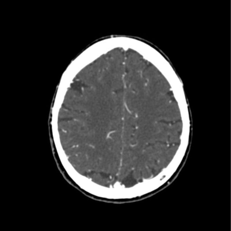 CTA Head Phantom for CT Scan & X-Ray Training - High-Quality Medical Imaging Education Tool for Radiology Students & Technicians