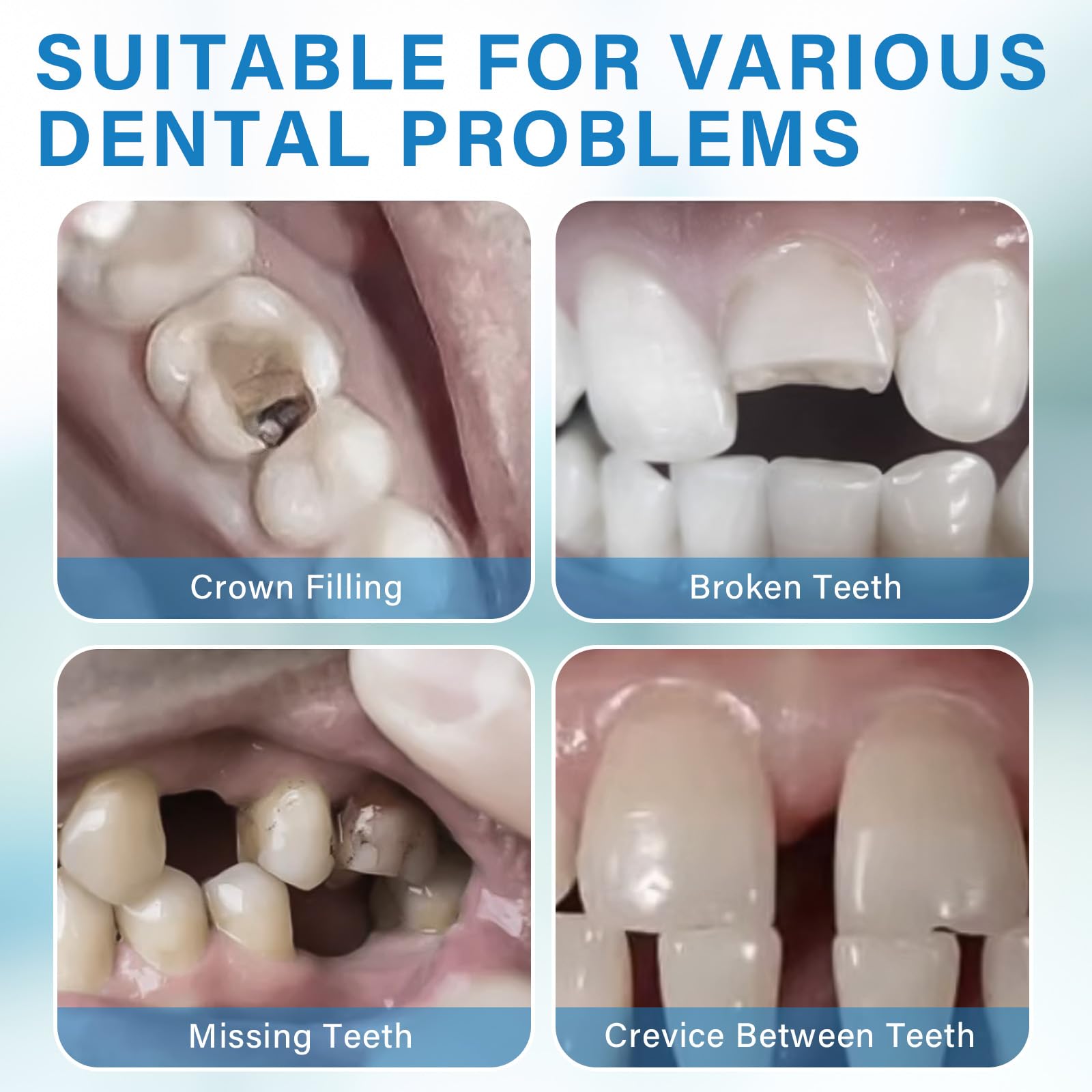 Dental Repair Kit for Broken & Missing Teeth - Temporary Tooth Filling Material, Emergency Dental Care Solution for Pain Relief & Cavity Repair - Regain Confidence with Natural-Looking Smile (Off White) - Perfect for Travel, Home Use & Dental Emergencies
