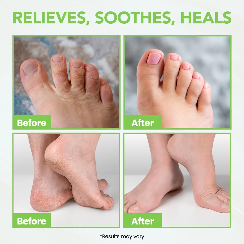 Extra Strength Athlete's Foot Balm & Treatment Cream - Heals Dry, Cracked Feet, Itchy Skin & Nails | Advanced Foot Care for Men & Women | Perfect for Gym, Pool & Outdoor Activities