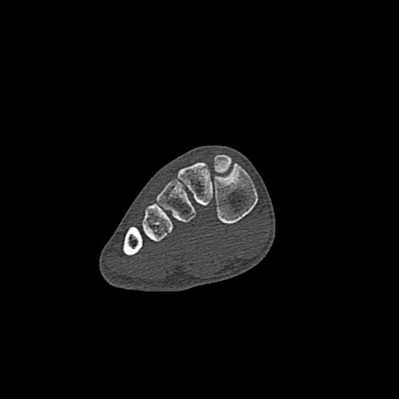 Foot Phantom Metatarsal Fractures Model - Realistic CT Scan & X-Ray Training Tool for Medical Students & Radiologists - Perfect for Anatomy Study & Diagnostic Practice