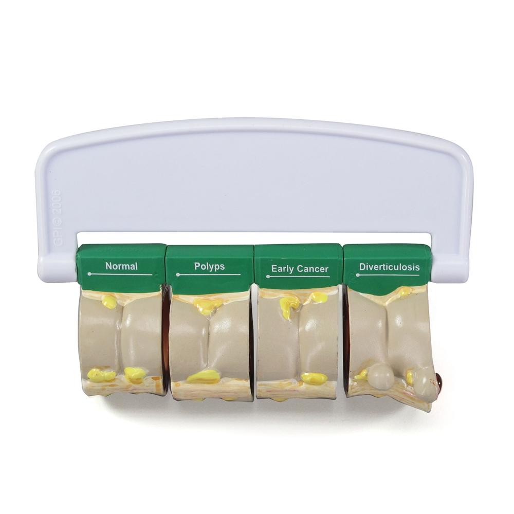 4-Piece Colon Anatomy Model with Pathologies - Ideal for Medical Students, Doctors & Healthcare Professionals