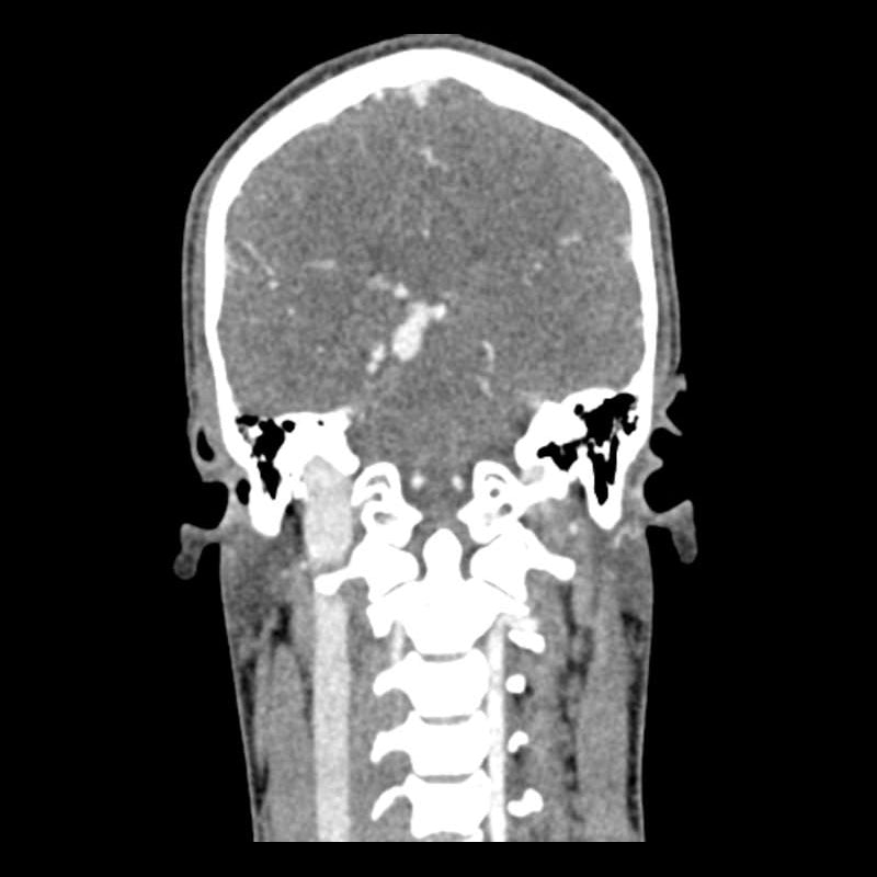 Head and Neck CTA Phantom AVM for CT Scan & X-Ray Training - Medical Imaging Practice, Radiology Education, and Diagnostic Testing