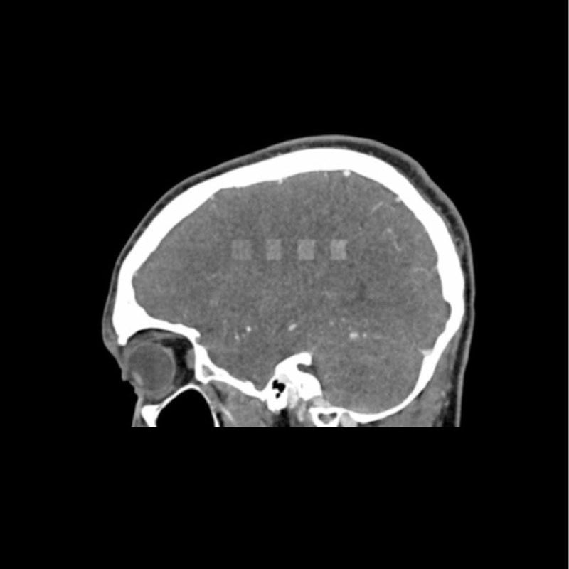 CTA AVM / Lesion Head Phantom - High-Quality CT Scan & X-Ray Training Tool for Medical Students & Radiology Professionals | Perfect for Diagnostic Imaging Practice & Medical Education