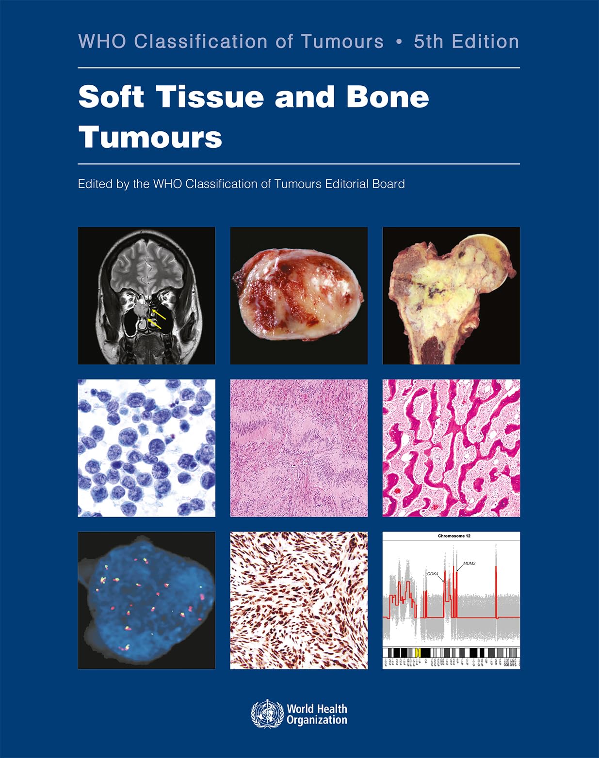 Soft Tissue and Bone Tumors: WHO Classification of Tumors (Medical Reference Book) - Essential for Pathologists, Oncologists, and Cancer Researchers
