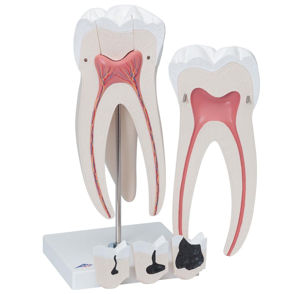 Giant Molar with Cavities - 15x Life Size Dental Model (5-Part) - Perfect for Dental Education, Classroom Demonstrations & Medical Training