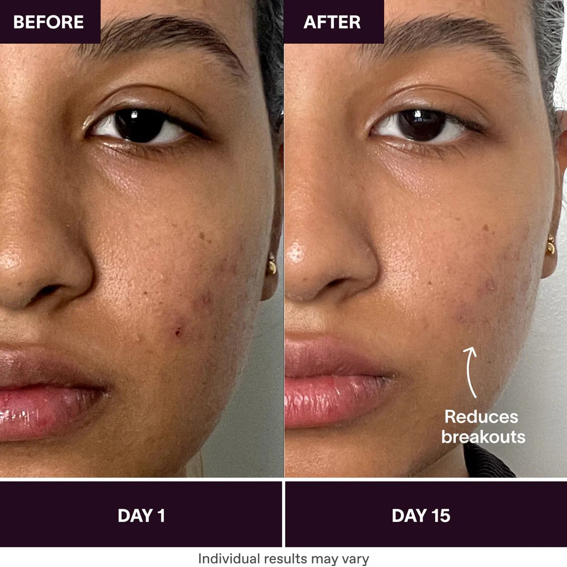 Bye Acne 3 Minute Light Therapy Spot Treatment for Face - Fast Acne Removal & Skin Clearing Device for Teens & Adults | Perfect for Home Use & Travel