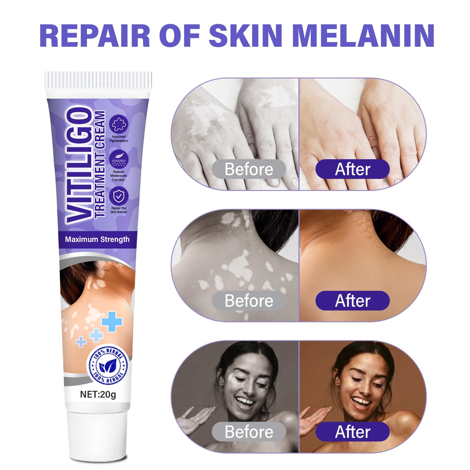 Natural Vitiligo Treatment Cream for Skin Pigmentation - Safe & Effective Solution to Restore Skin Tone | Perfect for Daily Use on Face & Body