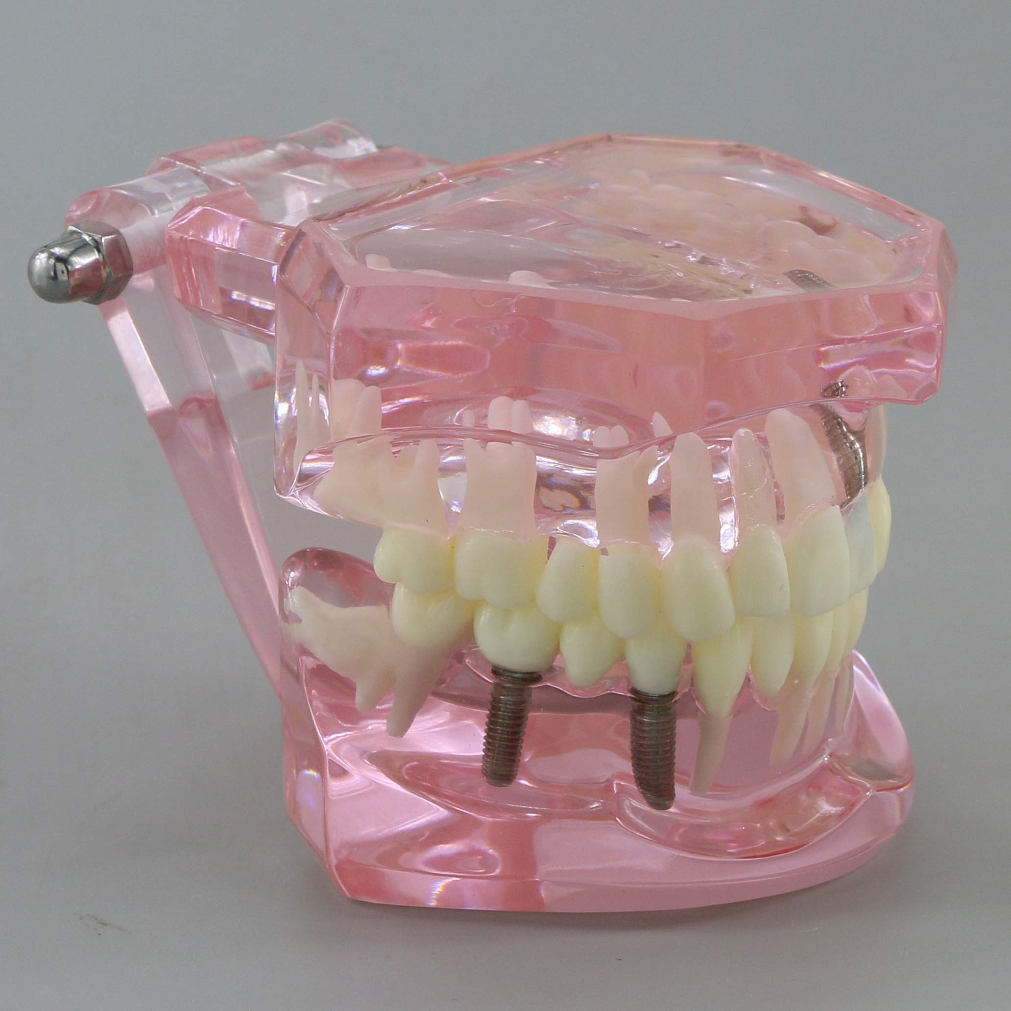 Dental Teeth Model - Implant Restoration Bridge Typodont for Dental Teaching & Study - Oral Pathology Demonstration (M2001 Pink) - Perfect for Dental Schools, Clinics & Training Labs