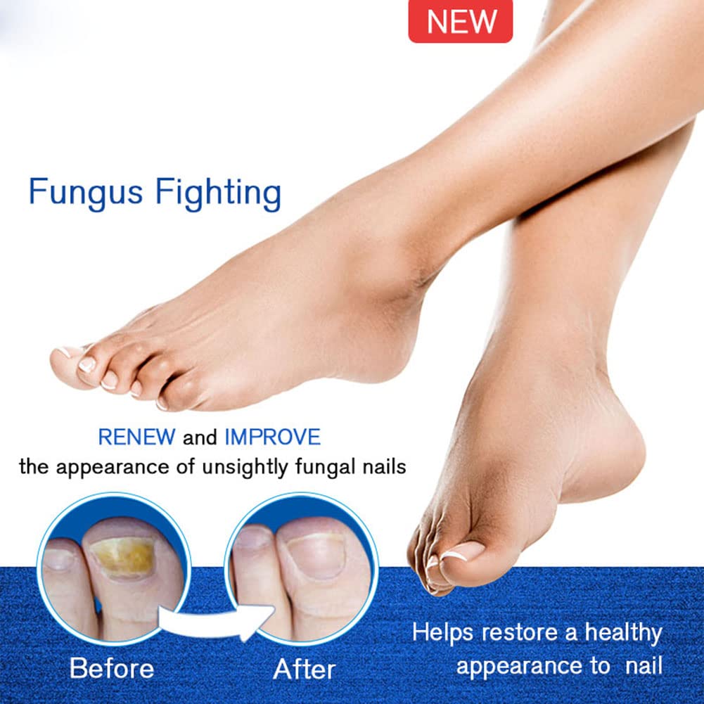 Ofanyia Anti-Fungal Nail Treatment Pen for Toenail & Fingernail Fungus Repair - Strengthens Brittle Nails & Promotes Healthy Growth - Effective Nail Care Solution for Athletes, Swimmers & Daily Use